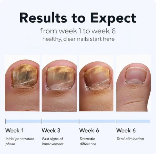 FungalFix™ - Fungal Nail Renewal Patches