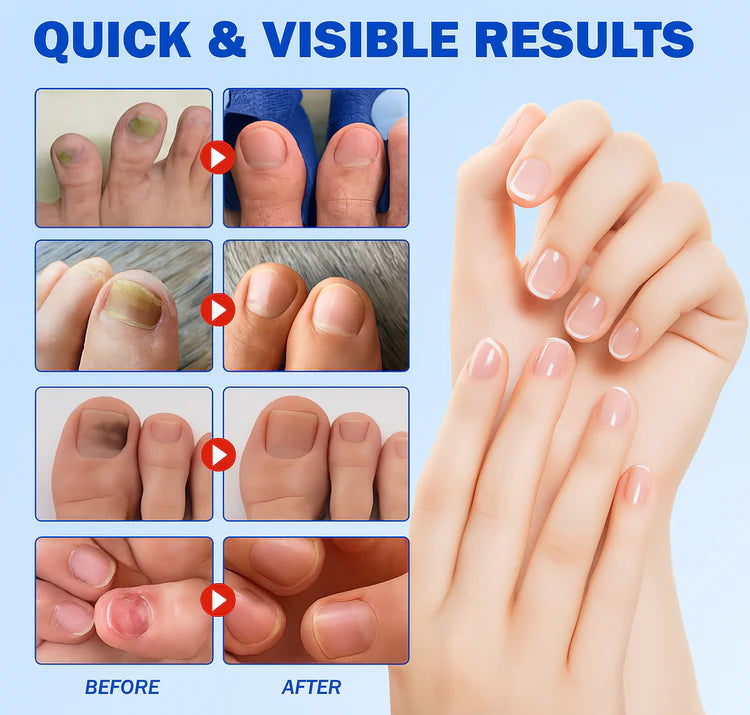 FungalFix™ - Fungal Nail Renewal Patches