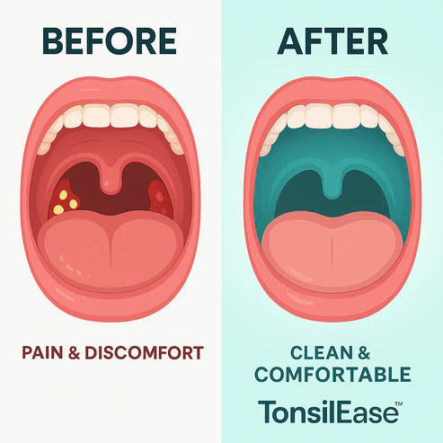 TonsilEase™ - Tonsil Stone Removal Kit
