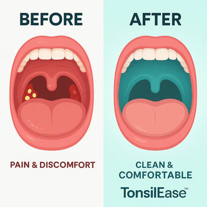 TonsilEase™ - Tonsil Stone Removal Kit